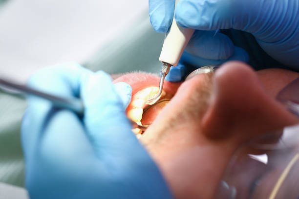 Best Emergency Dentist for Lost Fillings or Crowns in Arlington, TX